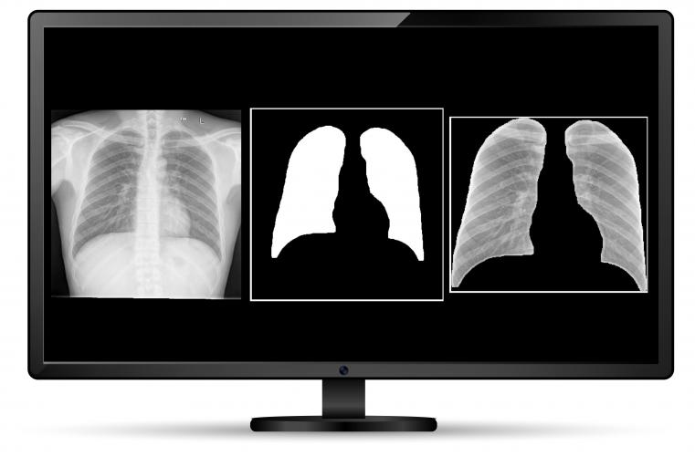 Mapa de calor identifica regiões de uma radiografia que mais impactaram nos resultados