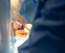 Esperança: HUOP realiza aplicação de polilaminina e marca momento histórico na assistência a pacientes com lesão medular