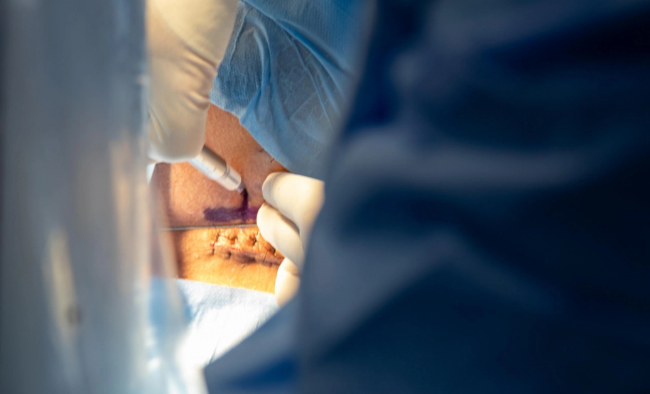 Esperança: HUOP realiza aplicação de polilaminina e marca momento histórico na assistência a pacientes com lesão medular